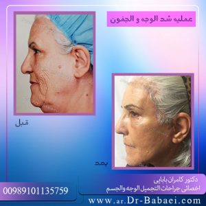 مرشحون لشد الوجه