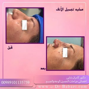 فوائد جراحة الأنف المغلقة    