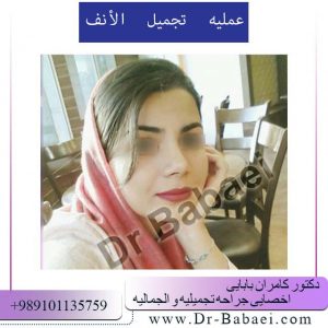 عملیه الانف
