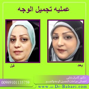 شد الوجه في الاهواز