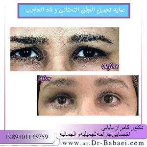 جراحة الأجفان في الاهواز