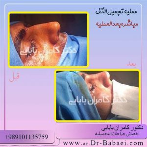عملیه تجميلیه الأنف المفتوحه