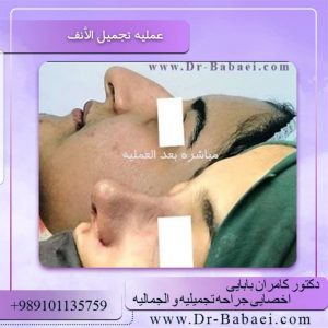 جراحة الأنف في المرضى الذين يعانون من التهاب الجيوب الأنفية    