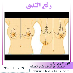 رفع-الثدی