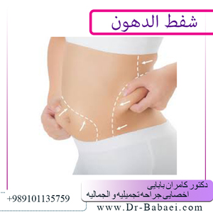 شفط-الدهون